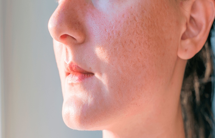 What Causes Acne Scars_