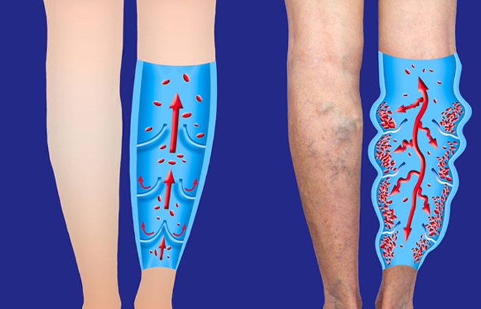 Healthy Veins Write For Us